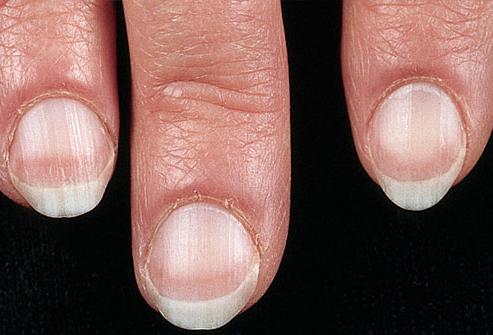 Sunt bolile unghiilor periculoase pe mâini?